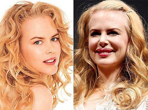 Thiên nga nước Úc Nicole Kidman có đôi môi dị dạng khó tin.
