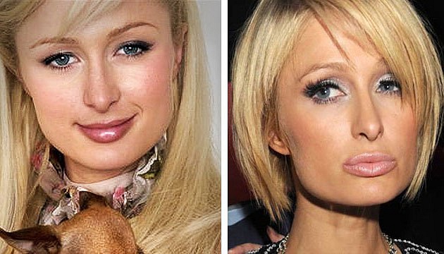 Paris Hilton thì có lẽ sẽ hối hận vì không... giữ đôi môi tự nhiên khi so sánh hình ảnh trước và sau khi thẩm mỹ.