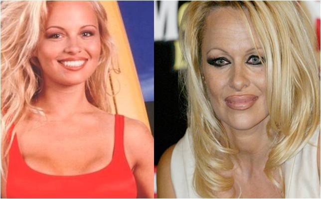 Pamela Anderson vừa bơm môi vừa tham lam tô son tràn môi khiến cô già đi chục tuổi.