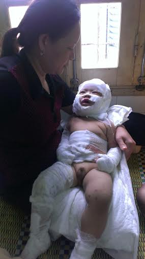 Cháu Dũng (2 tuổi) bị bỏng nặng, quấn toàn thân