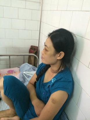 Chị Hoa kể lại những vết thương do chồng đánh đập