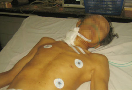 Ông Phạm Văn Bảy đang được điều trị tại bệnh viện với vết thương 