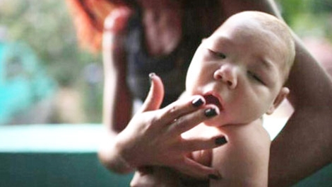 Bệnh teo não ở trẻ sơ sinh do mẹ nhiễm virus zika.