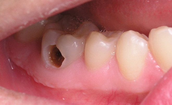 sâu răng 