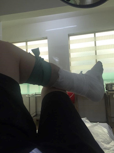 Suýt mất chân vì bác sĩ bỏ quên gạc sau khi phẫu thuật