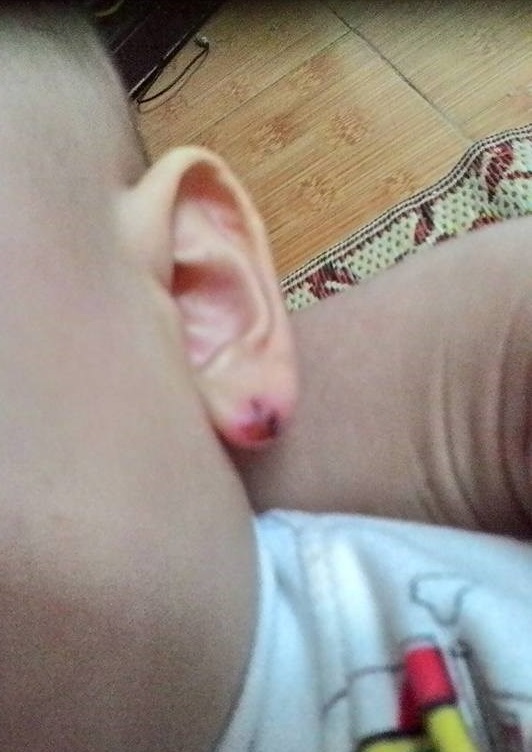 Bé trai bị cắn tím người, sứt tai khi ở trường mầm non về