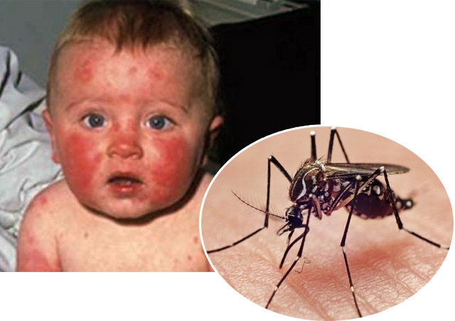Thử nghiệm thành công vắcxin ngừa virus Zika trên động vật