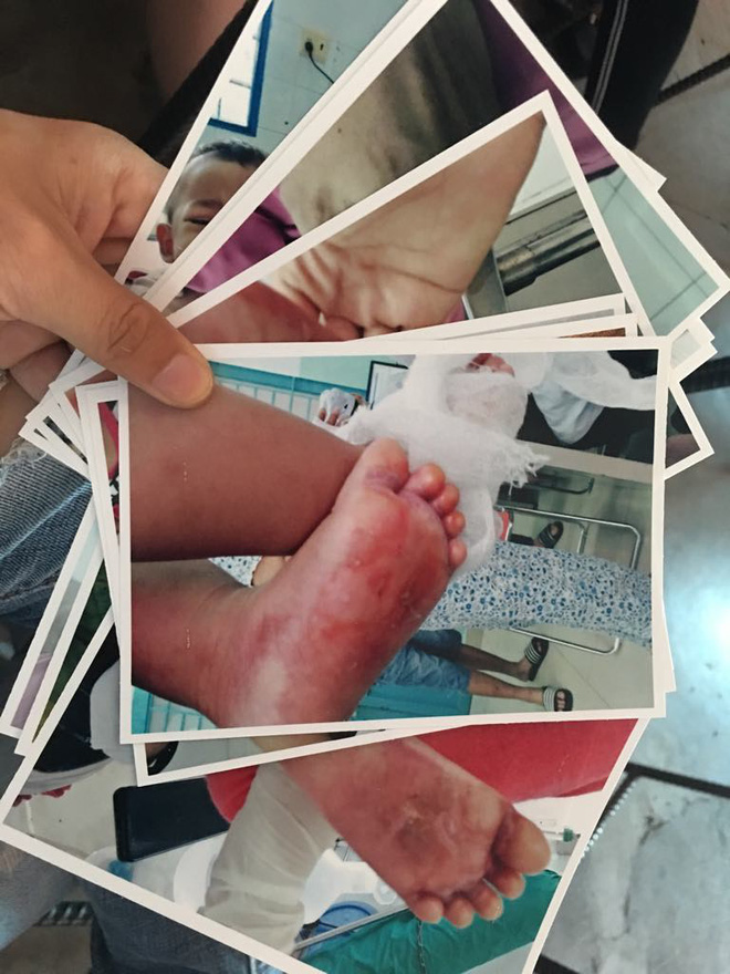 Hình ảnh vết bỏng ở bàn chân của bé được chụp lại sau đó.
