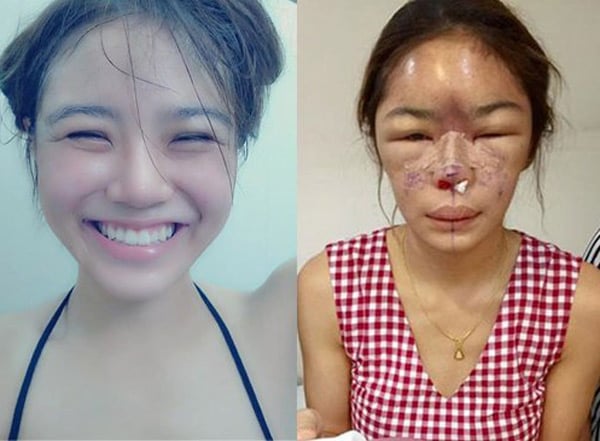Taiwanrat Fah Chaiamnuay (một hot girl trên mạng xã hội Thái Lan) đã bị chất dịch silicon chảy tràn khắp mặt khiến gương mặt bị biến dạng khó coi, chảy máu sau khi PTTM.