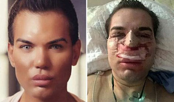 Rodrigo Alves - một tín đồ của phẫu thuật thẩm mỹ, nổi tiếng với biệt danh 'búp bê Ken' sống đã phải nhập viện vì bị nhiễm vi khuẩn ăn thịt trong quá trình phẫu thuật mũi. 