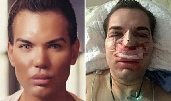 Rodrigo Alves - một tín đồ của phẫu thuật thẩm mỹ, nổi tiếng với biệt danh 'búp bê Ken' sống đã phải nhập viện vì bị nhiễm vi khuẩn ăn thịt trong quá trình phẫu thuật mũi. 