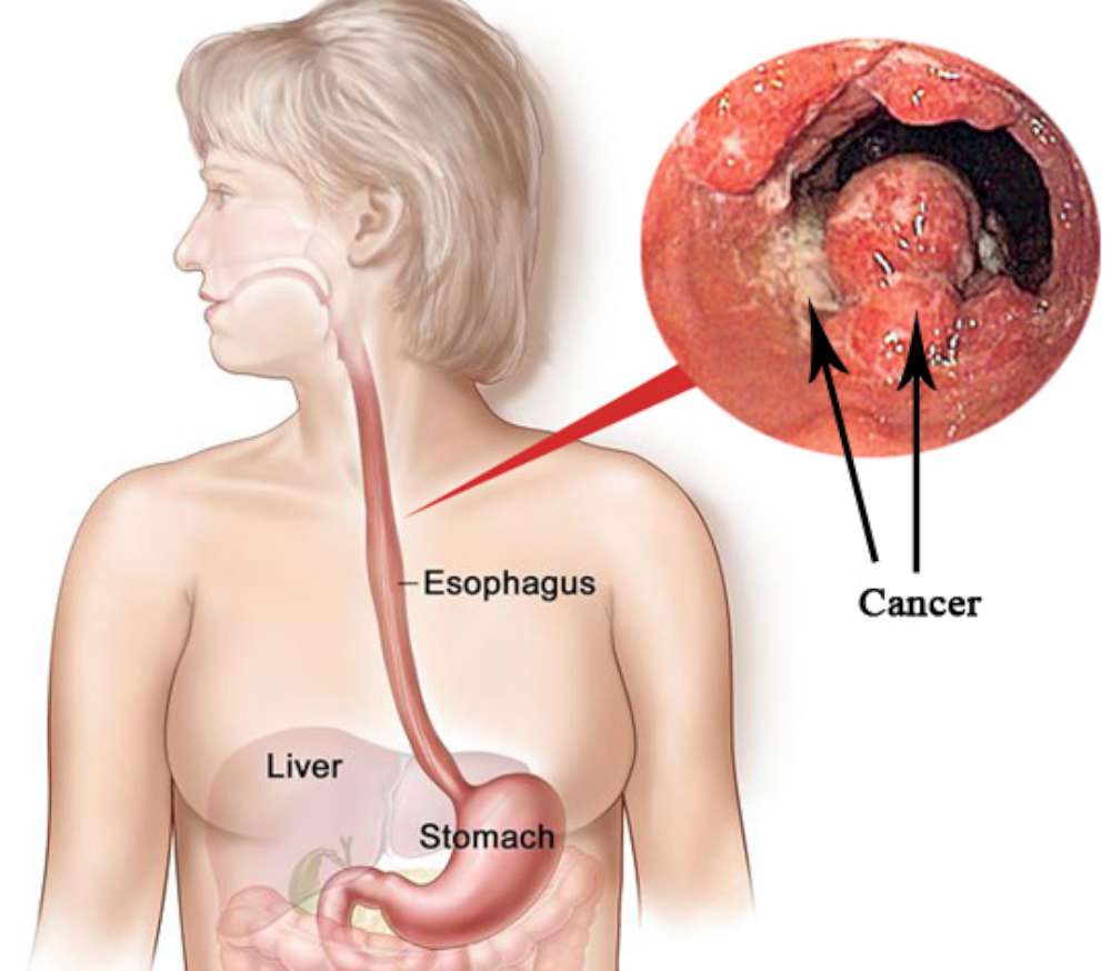 ESOPHAGEAL-CANCER-1