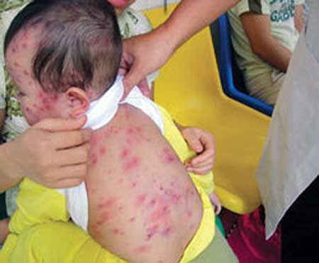 20140213152358-patient-measles