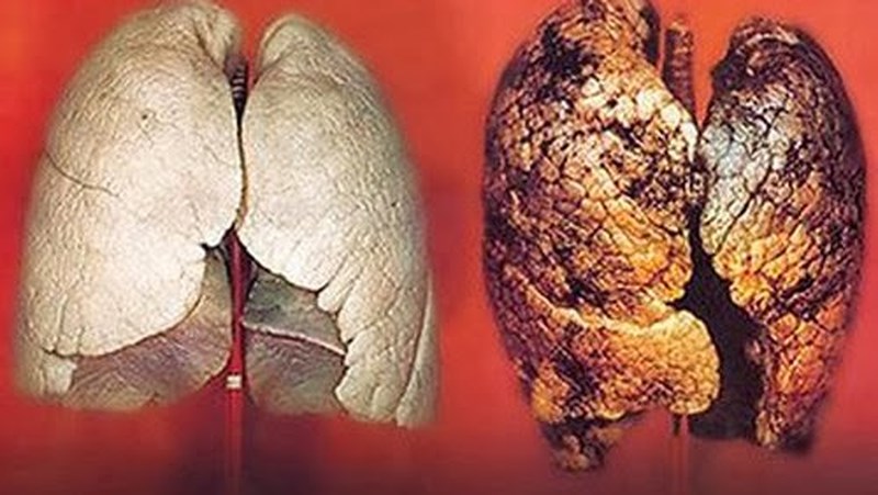 Không hút thuốc vẫn có nguy cơ mắc ung thư phổi