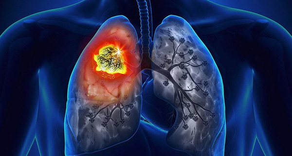 Bị ung thư phổi có liên quan rất lớn đền việc thường xuyên tiếp xúc với khói dầu trong nhà bếp.