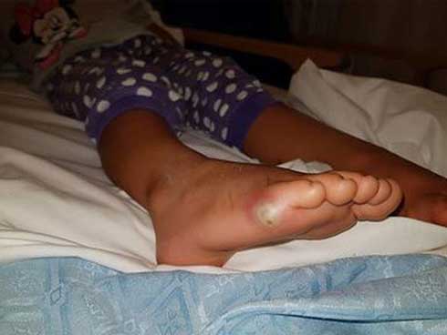 Vi khuẩn đã xâm nhập vào cơ thể của Sienna thông qua vết thương hở nhỏ xíu trên chân bé.