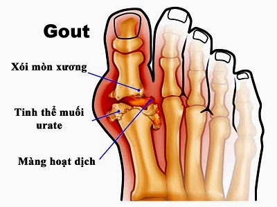 benh-gout