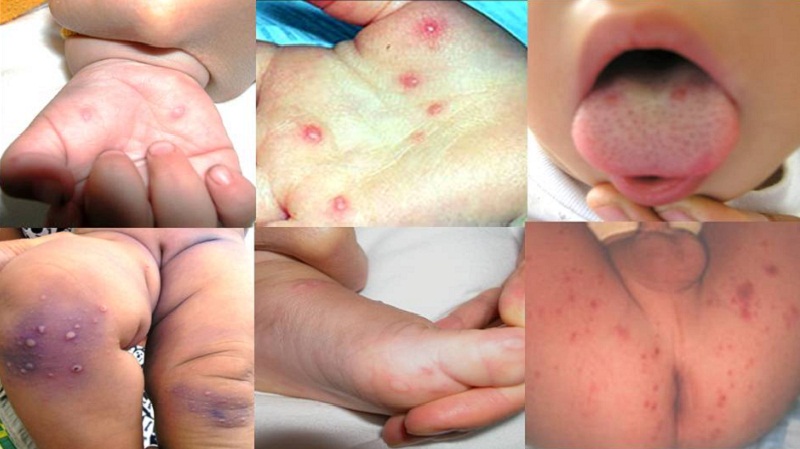 Đây là bệnh xảy ra quanh năm, thường gặp nhiều nhất ở trẻ dưới 3 tuổi đặc biệt những bé có sức đề kháng yếu.Trẻ nhỏ có sức đề kháng yếu có nguy cơ cao mắc bệnh chân tay miệng