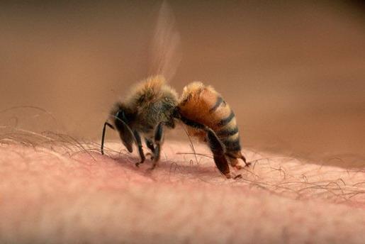 Bước đầu tiên sơ cứu tại nhà là lấy nhíp gắp nọc ong đốt
