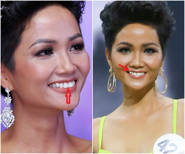 Trước đó, H'Hen Niê sở hữu hàm răng không được đều đặn ở thời điểm đăng quang Hoa hậu Hoàn vũ Việt Nam 2017. Mặc dù vẻ đẹp rất cá tính và quyến rũ nhưng hàm răng lại chính là điểm trừ của chân dài Ê Đê.    