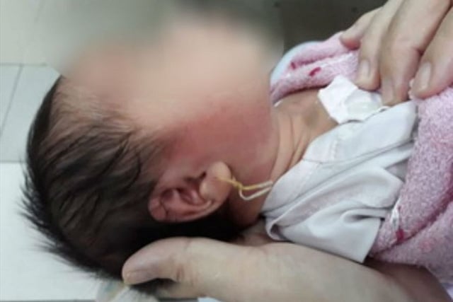 Hình ảnh lỗ tai bị sưng tấy nhiễm trùng của bé khi được người nhà xỏ lỗ tai    