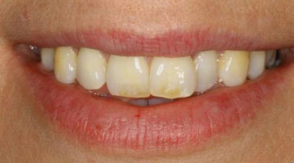 Dấu hiệu lạ ở răng miệng cảnh báo nguy cơ mắc 5 bệnh nguy hiểm, hãy nhanh chóng đi gặp bác sĩ ngay