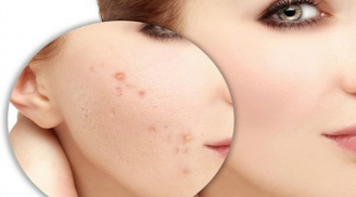 Có dấu hiệu lạ trên mặt thì dừng tẩy da chết ngay kẻo da sần sùi, mọc đầy mụn