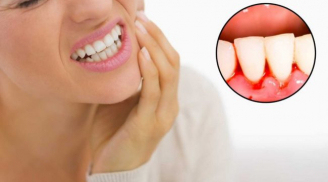 Dấu hiệu của răng miệng báo động tim, gan, thận không khỏe: Chảy máu, đổi màu nướu đi khám ngay