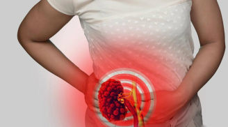 Dấu hiệu và triệu chứng cảnh báo sỏi thận mà rất nhiều người mắc phải