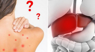 Những dấu hiệu cảnh báo bệnh gan mà bạn không thể bỏ qua, nhất là số 1