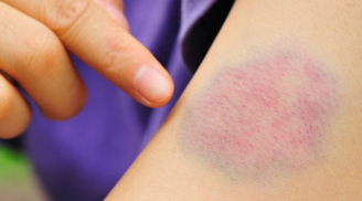 Những cách làm tan máu bầm nhanh chóng và hiệu quả ngay tại nhà