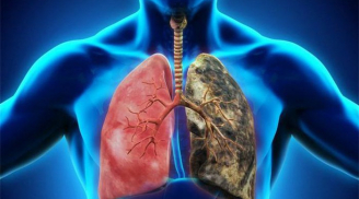 Những thực phẩm là 'sát thủ' hại phổi không kém gì khói độc