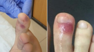 Phát hiện triệu chứng mắc Covid-19 mới: Xuất hiện 'điểm lạ' trên chân bệnh nhân