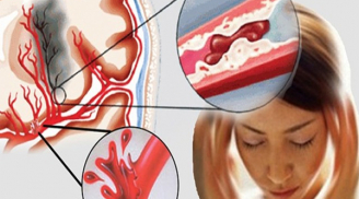 Dấu hiệu chứng tỏ não không được cung cấp máu đầy đủ