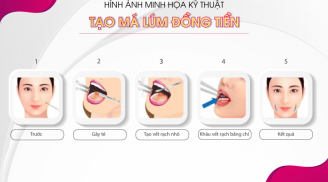 Tạo má lúm đồng tiền - Bí quyết “trang điểm” nét duyên trên gương mặt