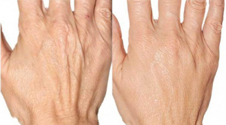 Cách cải thiện và trẻ hóa làm da tay nhăn nheo chỉ sau 1 tuần
