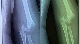 Tin mới nhất vụ bé gái 5 tuổi ở gãy lìa xương khuỷu tay ở trường mầm non