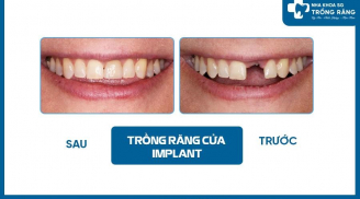 Trồng răng vĩnh viễn trả góp 0% chỉ từ 120.000 Đ/ngày