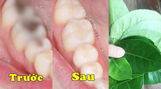 Trị dứt điểm sâu răng, viêm lợi, hôi miệng bằng loại lá rẻ bèo vườn nào cũng có, chợ nào cũng bán