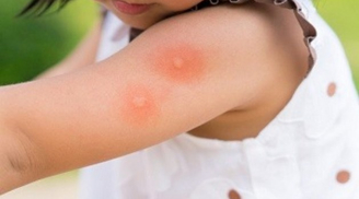 10 mẹo trị muỗi đốt cho trẻ bằng những thứ có sẵn trong nhà: An toàn, giảm sưng ngứa, khó chịu lập tức