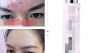 Chuộng xịt khoáng làm đẹp da: Bác sĩ cảnh báo hại nhiều hơn lợi!