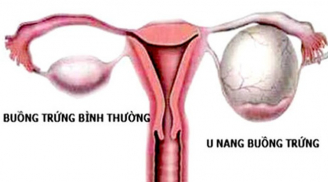 Những dấu hiệu cảnh báo u nang buồng trứng sớm nhất, chị em cần đi khám ngay