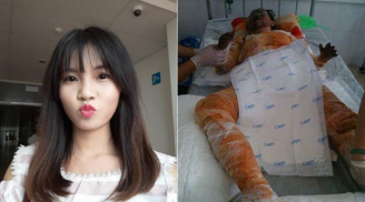 Đựng xăng vào túi ni lông: Cô gái xinh đẹp bị bỏng toàn thân, mặt biến dạng