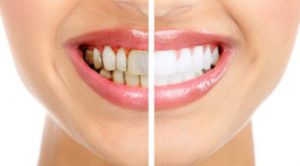 Răng ố vàng tới mấy chỉ cần sát thứ này lên cũng trắng như trứng gà bóc