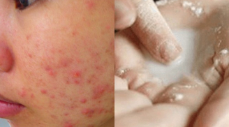 Không cần tốn tiền đi spa mụn trứng cá, vết thâm sẹo nặng đến mấy cũng hết nhờ 'thần dược' có sẵn trong bếp