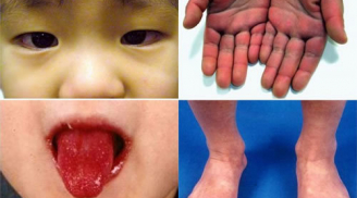 Bệnh lạ Kawasaki là gì mà khiến cha mẹ nào cũng lo lắng?