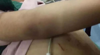 Bé gái 3 tuổi tử vong vì bị mẹ kế đánh đập dã man