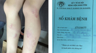 Hà Nội: Học sinh lớp 2 bị cô giáo đánh tím hai chân đến khi gãy thước vì ra chơi vào lớp muộn