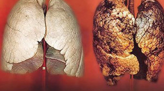 Đây chính là loại nước uống vào sẽ lọc sạch phổi cho người hút thuốc lá ai cũng nên biết để tự cứu mình