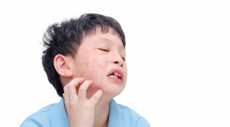 Bệnh quai bị là gì?